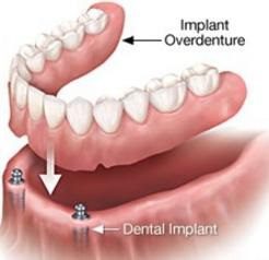 A diagram of an implant overdenture and dental implants.