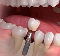 A close up of a tooth implant being placed in the mouth