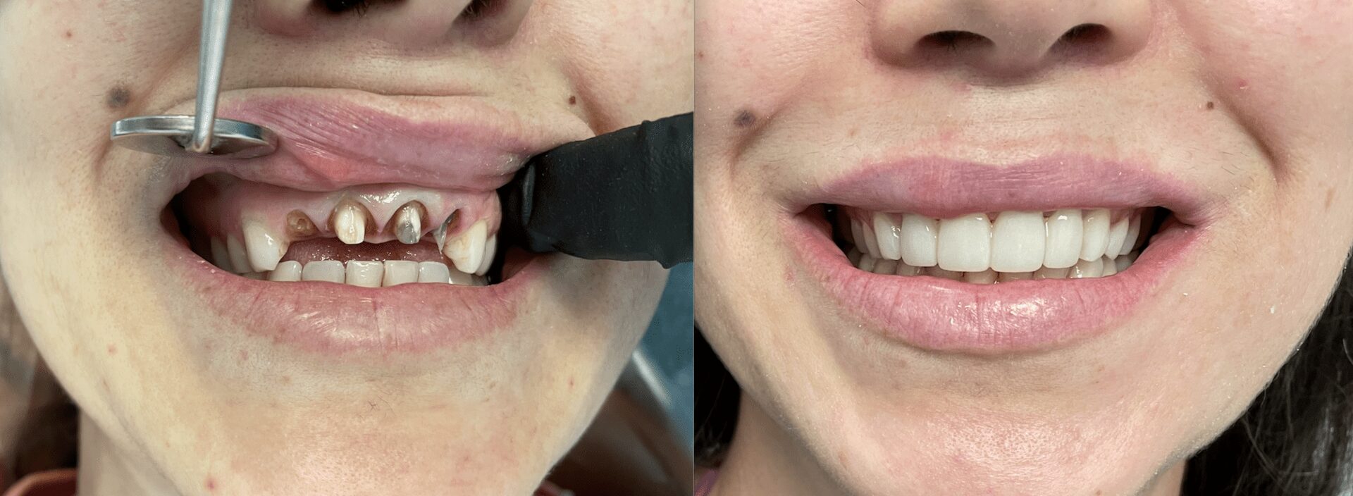 A woman with two different teeth brushing her smile.
