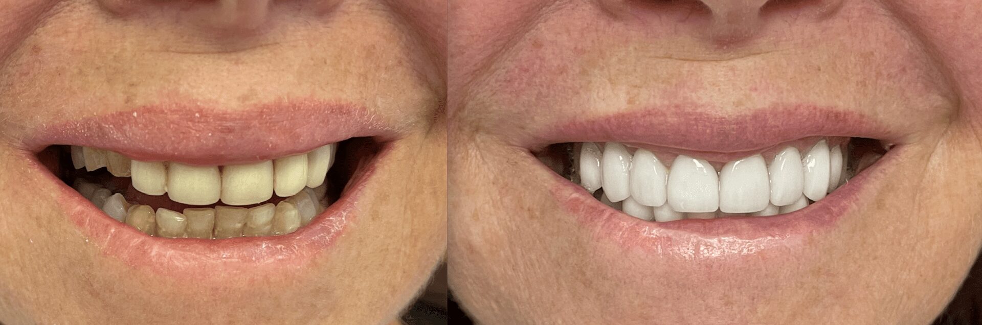 A before and after picture of teeth with missing tooth.