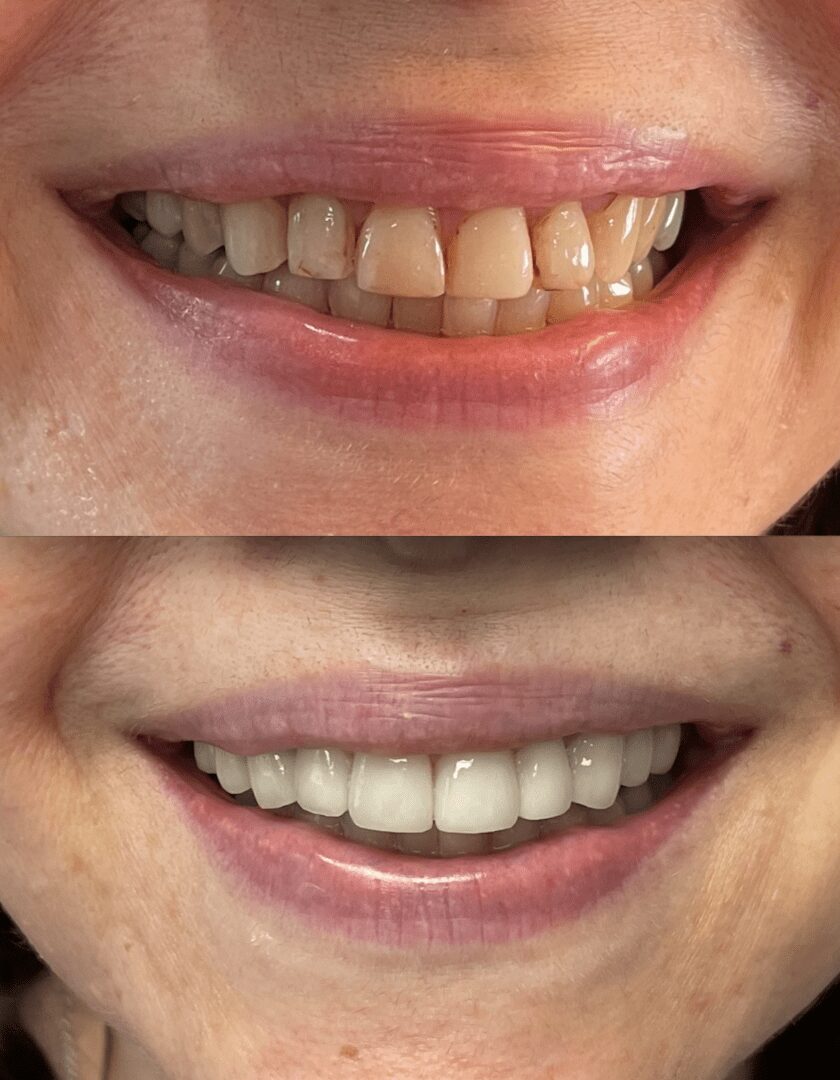 A before and after picture of teeth whitening