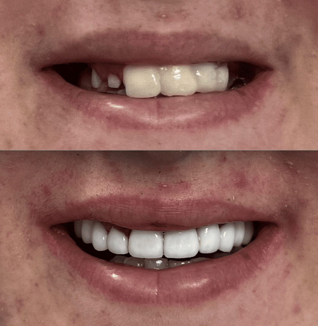 A before and after picture of teeth whitening.