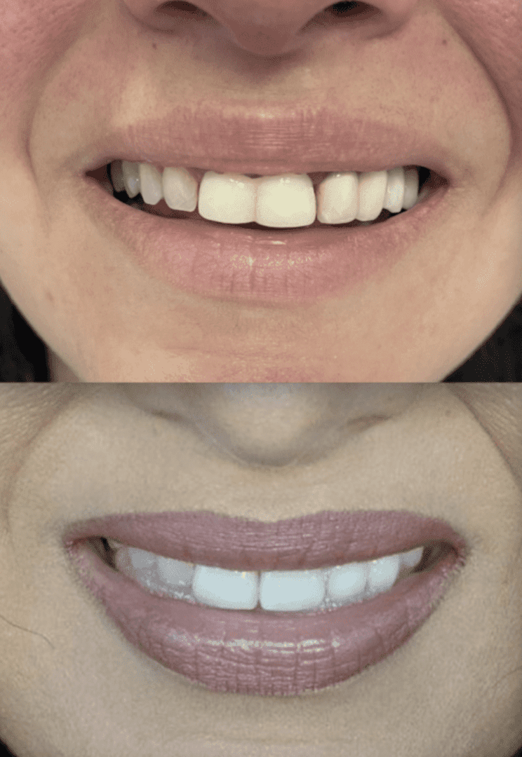 A woman with white teeth and brown lips.