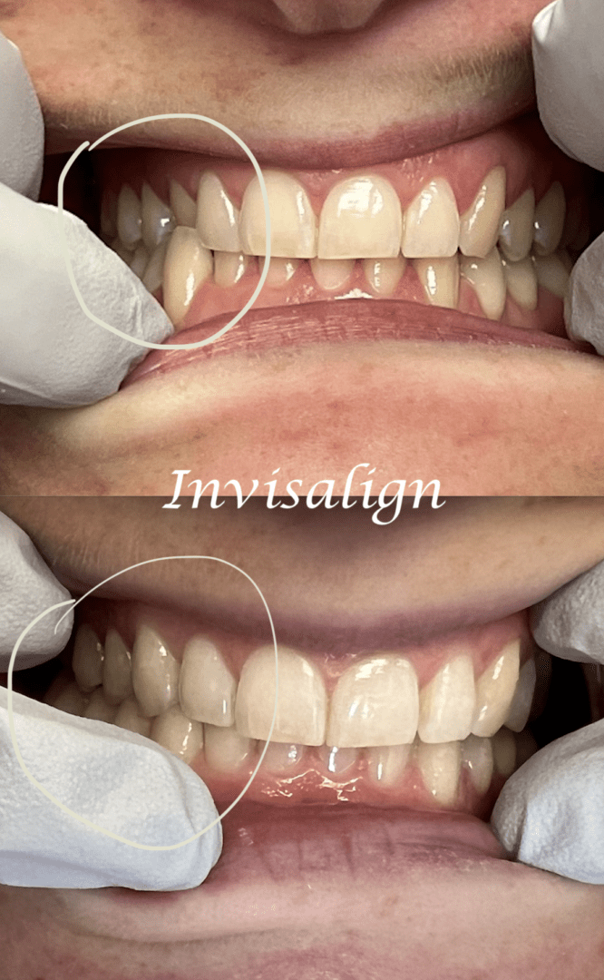 A close up of two people 's teeth with the word invisalign underneath them.