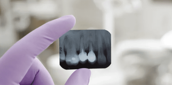 A person holding an x-ray of their teeth.