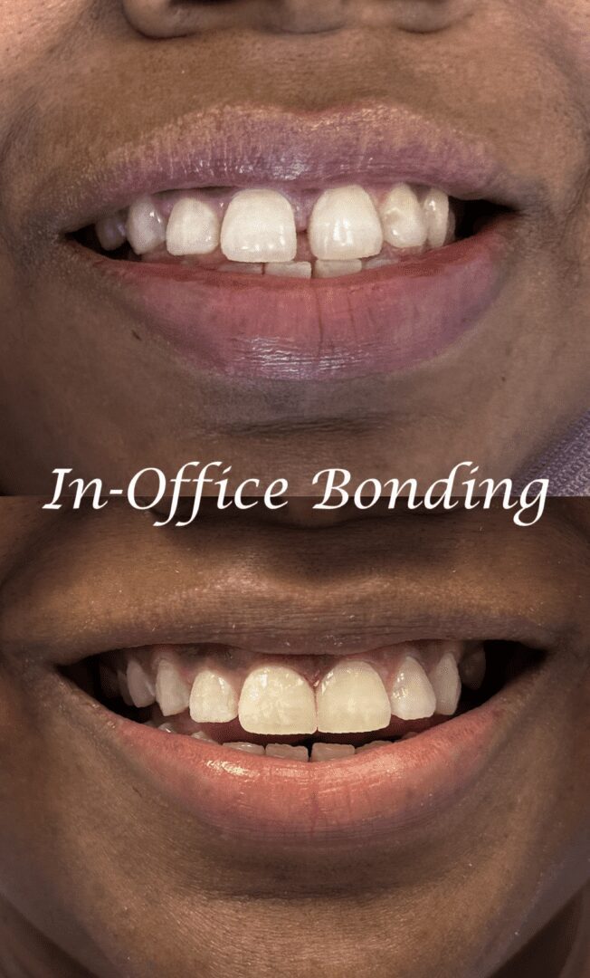 A before and after picture of teeth with in-office bonding.
