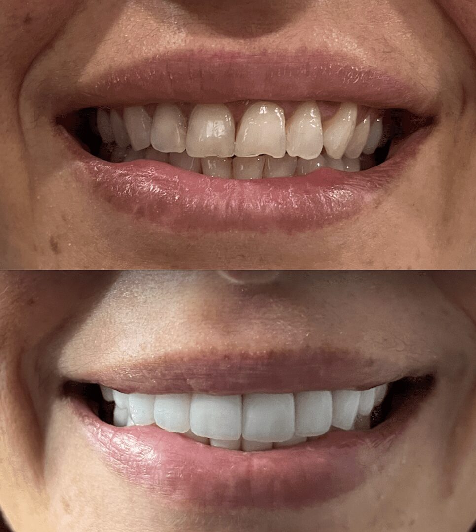 A before and after picture of the teeth whitening process.