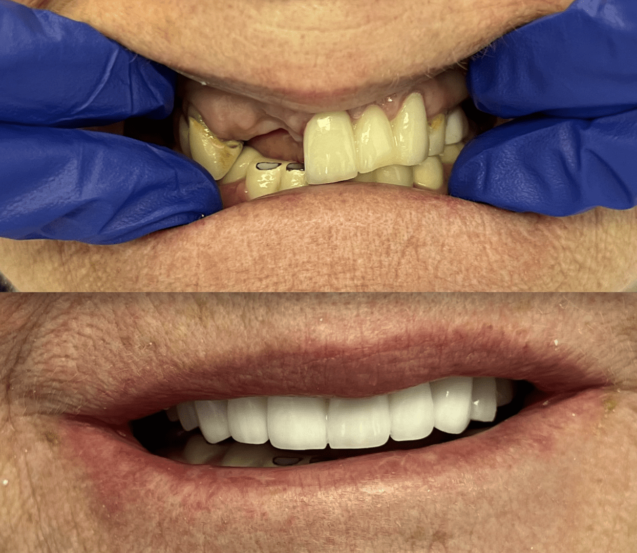 A before and after picture of the teeth being cleaned.