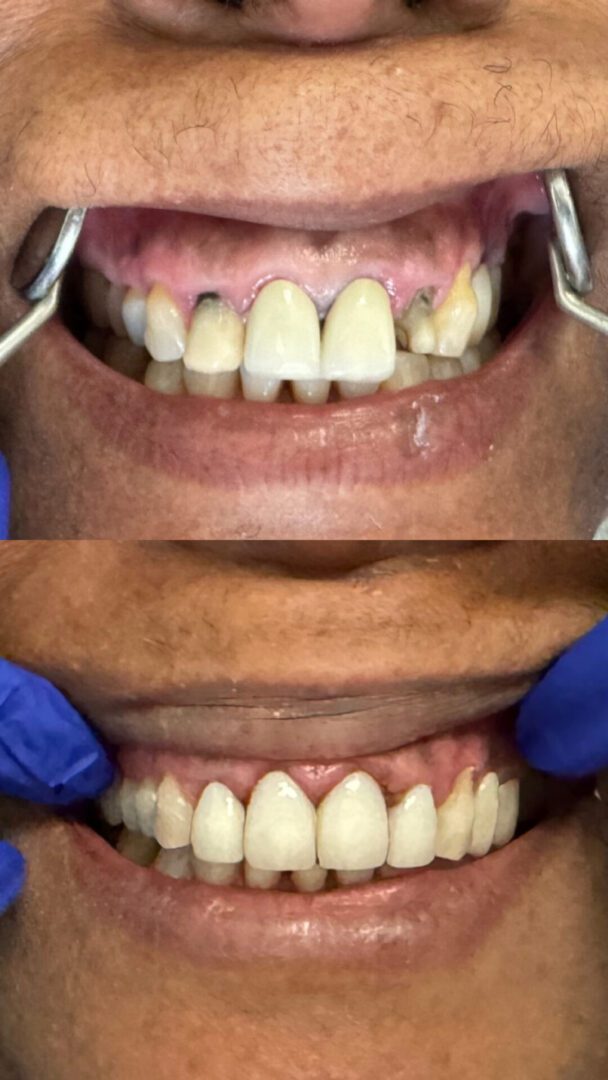 A before and after photo of someone 's teeth.